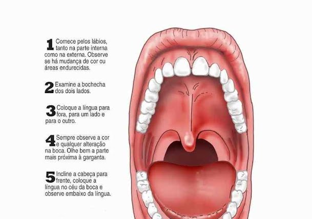 Como identificar placas na garganta de um paciente