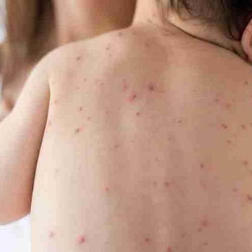 O preço da ignorância: mortes evitáveis e o ressurgimento de doenças esquecidas
