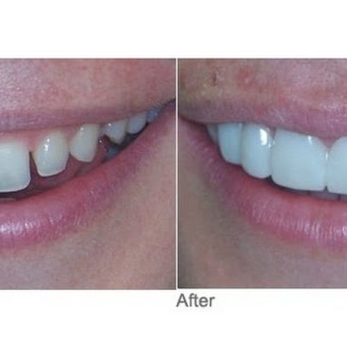 Snap on Smile – Solução moderna na “Odontologia Estética”