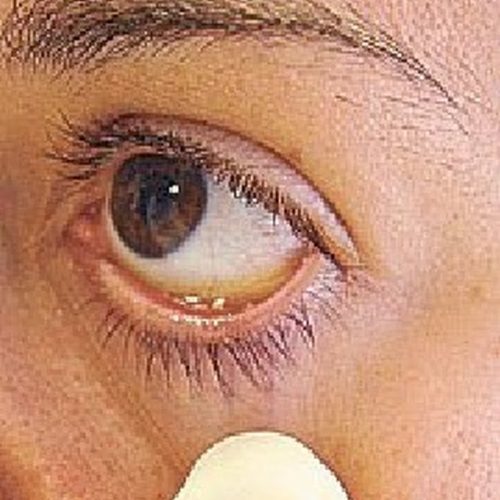 Saiba sobre a anemia e as fontes de ferro
