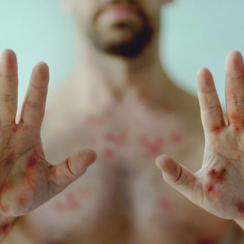 Minas Gerais confirma três casos de mpox em 2026