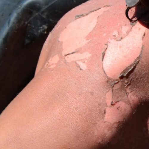 Confira dicas para cuidar da sua pele neste verão