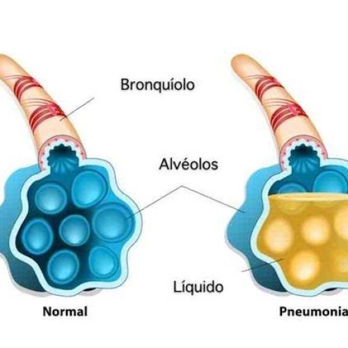 Dia Mundial da Pneumonia cuide-se
