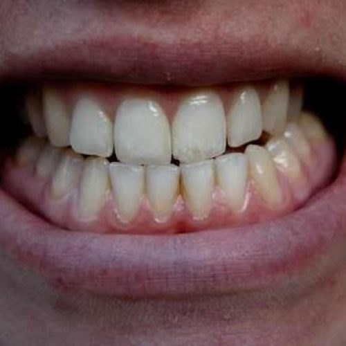 Tratamento com fisioterapia controla o Bruxismo e alivia seus sintomas