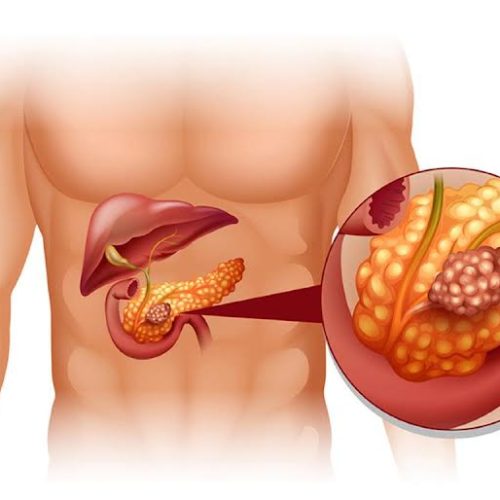 Saúde: metodologia inédita no país permite diagnosticar o câncer de pâncreas em até 72 horas
