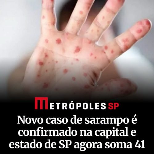 Estado de SP registra 41 casos de sarampo e reforça alerta para vacinação;