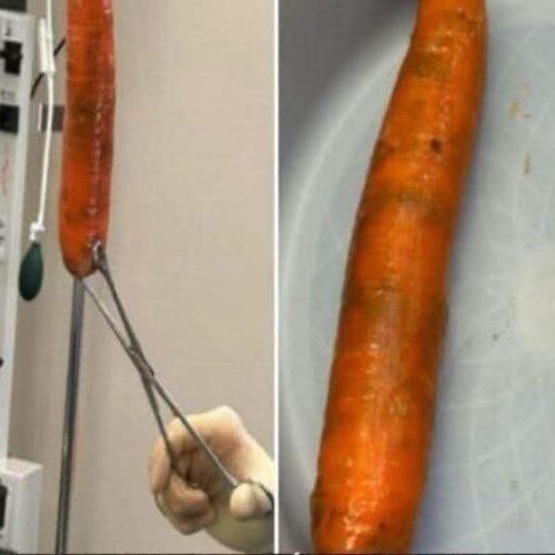 Homem passa por cirurgia após acordar com cenoura no corpo