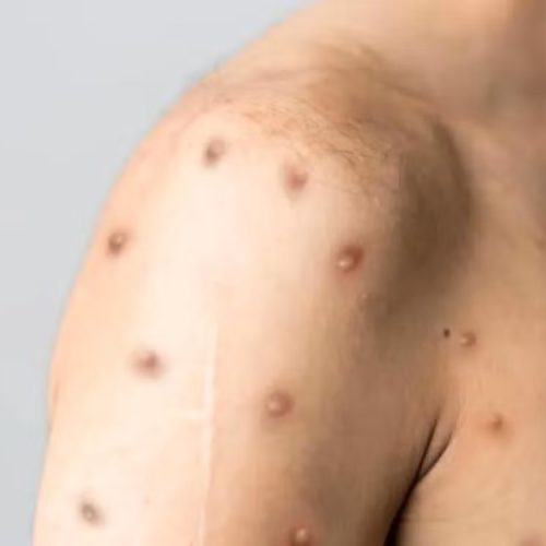 Mpox volta a ser registrada na região Central do estado de SP e acende alerta na saúde