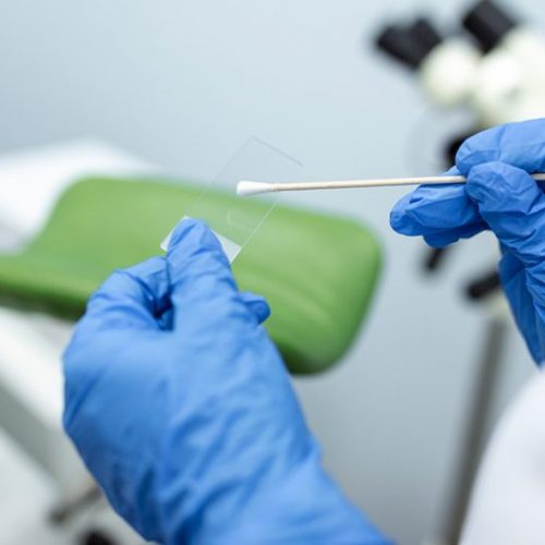 Ribeirão Preto é pioneira em adotar exame inovador para prevenção do câncer de colo de útero